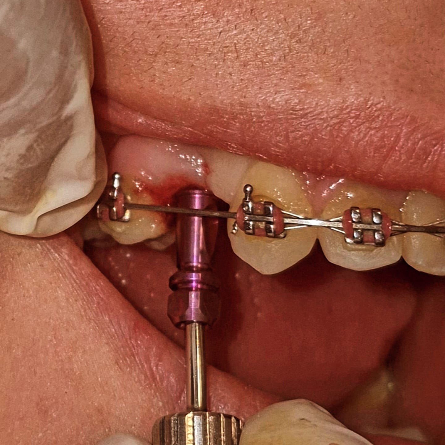 Blanqueamiento dental
