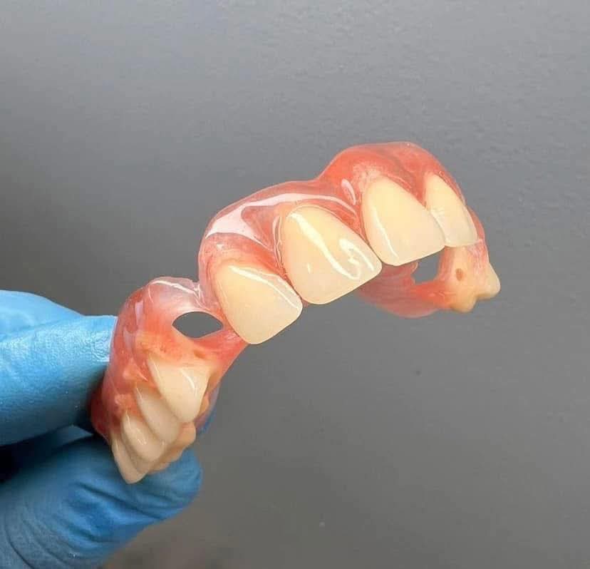 Carillas de porcelana