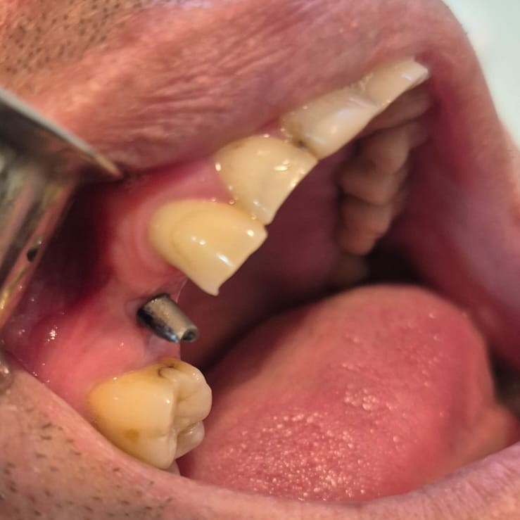 Implantes dentales